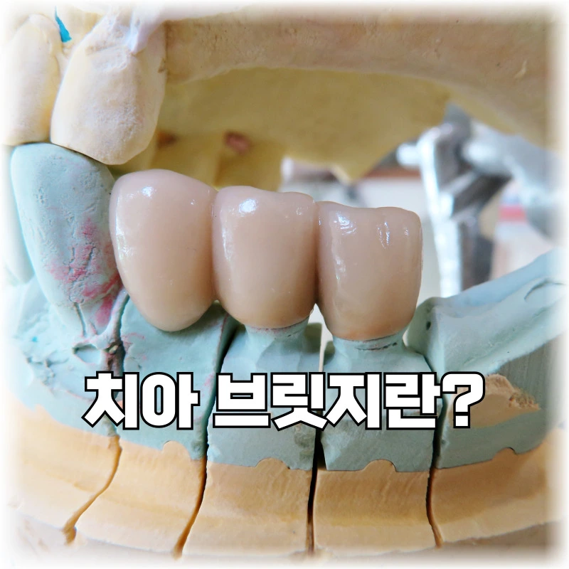 치아-브릿지란?