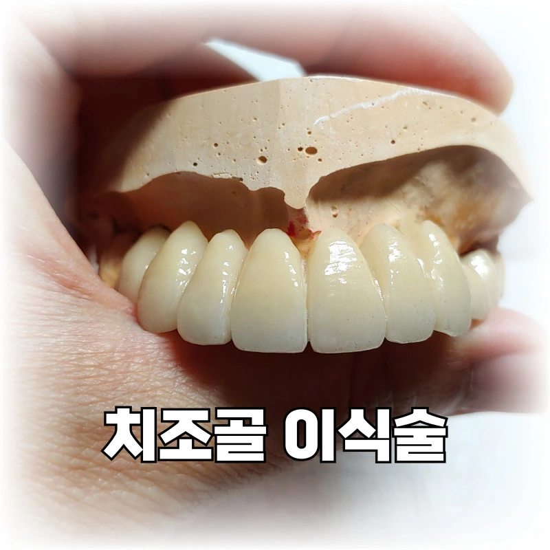 치조골-이식-수술의-필요성