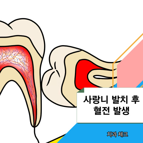 사랑니-발치-후-혈전